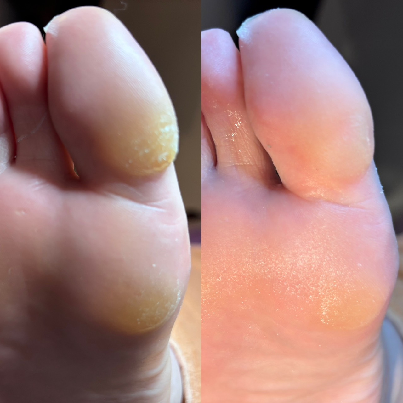 ビフォアフター写真2 フットケア フットケアサロン 魚の目ケア 足裏角質ケア タコケア 八尾 駅近 個室 エステ unaウナ☆エステ&アロマリラクゼーションサロン